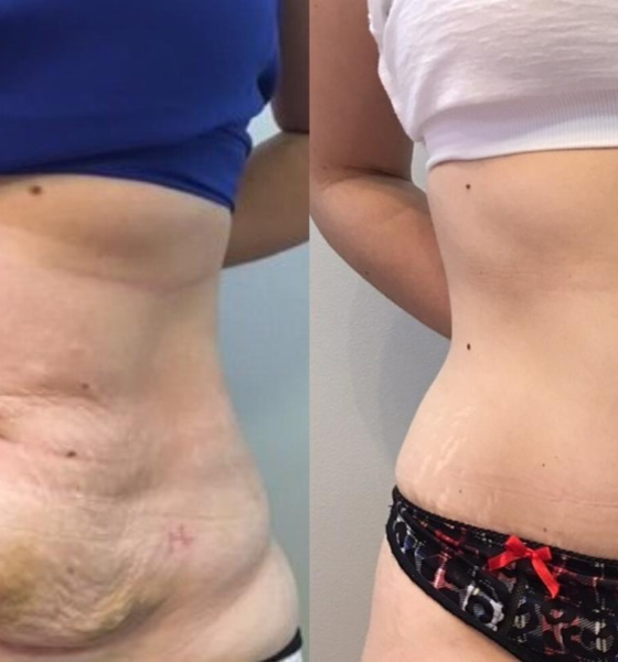 tummy tuck 102 view 1 detail