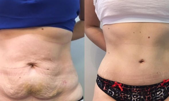 tummy tuck 102 view 1 detail
